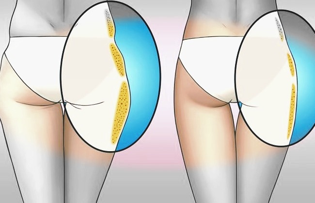 Как избавиться от "галифе" на ногах? Самый эффективный и простой способ.
