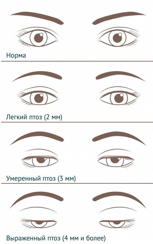 Тест веки. Птоз верхнего века, ретракция век. Птоз 1-2 степени верхнего века. Птоз 1 степени верхнего века. Птоз 2 степени верхнего века.