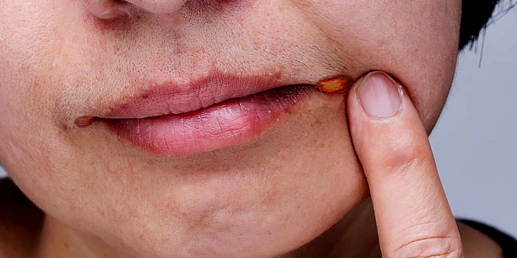 Заеды, ангулярный хейлит.