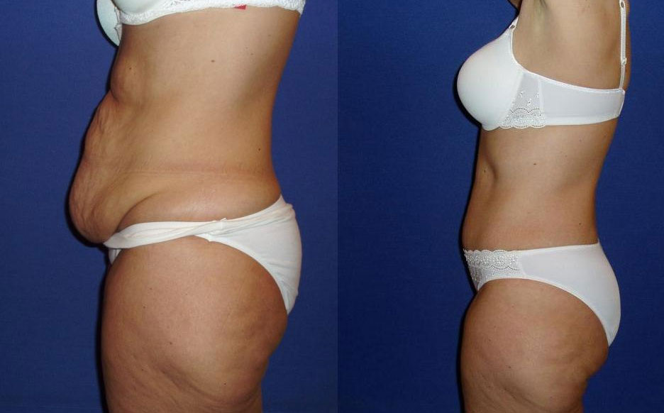 #худеемвместе #живот убирать #жиросжигание #плоский живот #красота и здоровье 