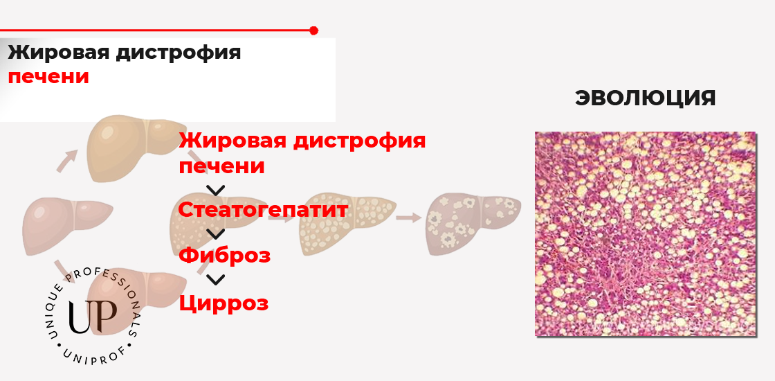 На слайде изображен гистологический материал, характерный для жировой дистрофии печени (окрашивание по Конго-рот). Структура печени уже фактически не различима, видны лишь капли жира.  