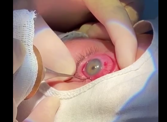    Оренбургские офтальмологи извлекли из глаза подростка железную стружку длиной 2 см Белов Михаил Александрович