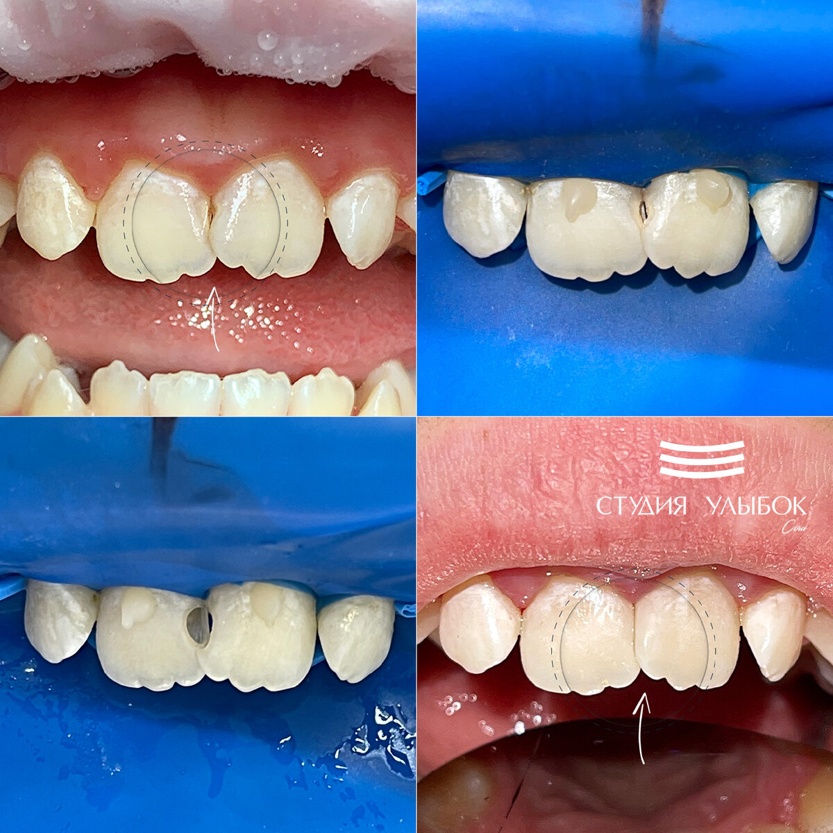 На снимках результат лечение кариеса дентита передних резцов верхней челюсти