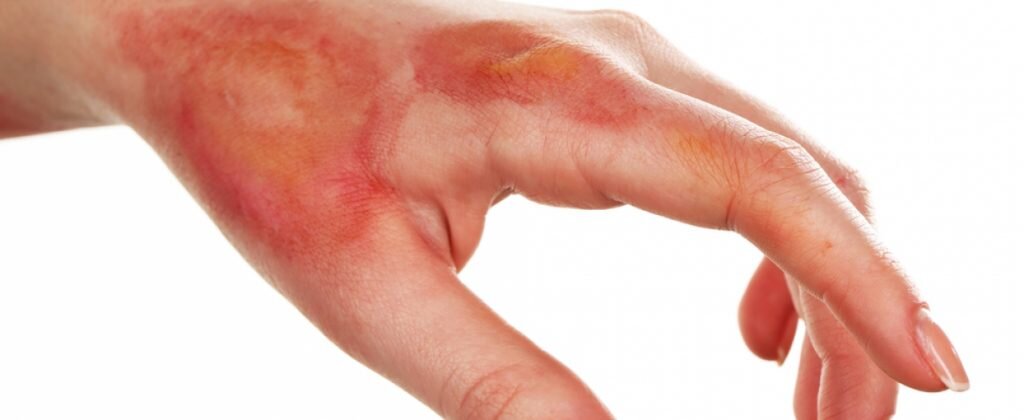 Пример термического ожога. Источник - ЯНДЕКС КАРТИНКИ