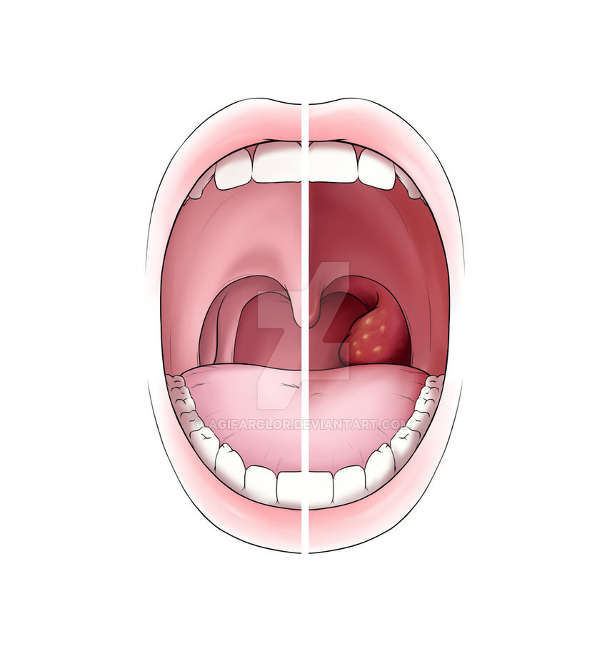 Ангина небных миндалин. Небные миндалины тонзиллит. Гнойная ангина тонзиллит. Бактериальный тонзиллит на миндалинах.