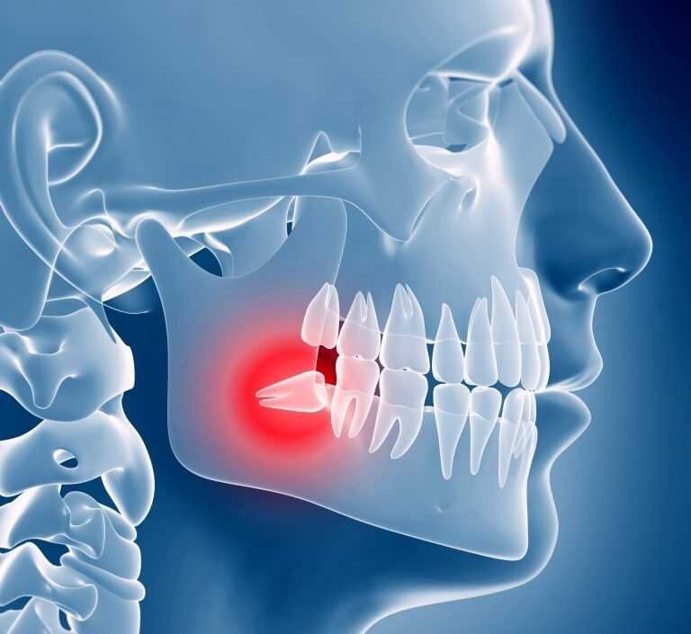 Признаки того, что режется зуб мудрости | Стоматология «Эстетика»