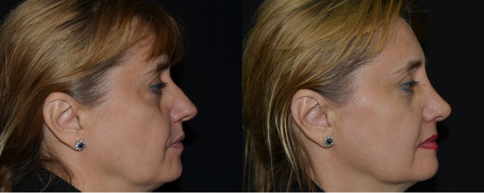 Фото до и после ринопластики с сайта хирурга Д.Р. Гришкяна, имеются противопоказания, требуется консультация специалиста. 