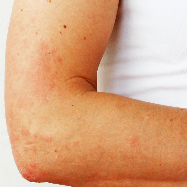 Через 2 минуты к волдырям постепенно добавляется мелкая сыпь белого или розового цвета, а кожа вокруг нее отекает