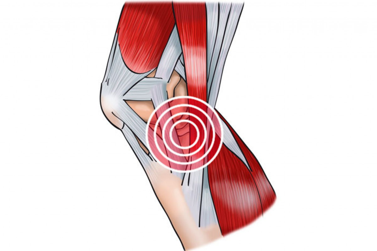 Тендинит сухожилия подколенной мышцы. Тинезит коленного сустава. Тандерид коленного сустава. Тендинопатия сухожилия подколенной мышцы.