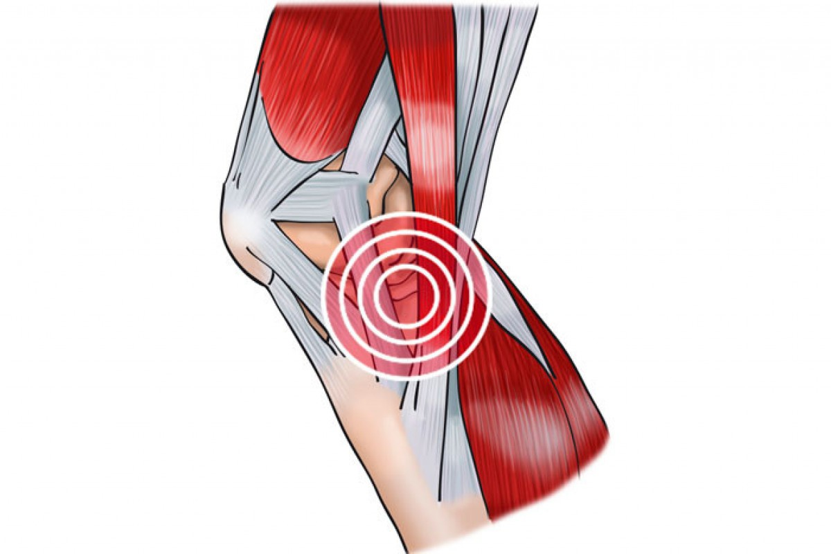 Тендинит коленного