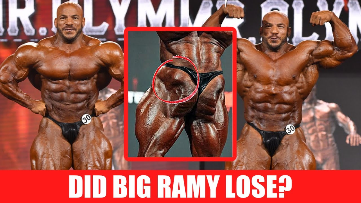 В интернете обсуждают фото, на которых видно что бывший Мистер Олимпия потерял часть левой ягодичной мышцы из за последствий по удалению абсцесса вызванного иньекцией стероидного препарата.