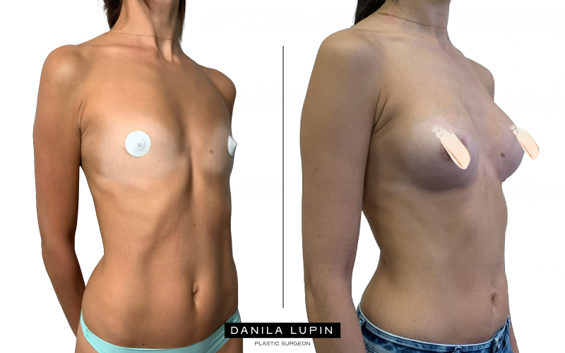 Маммопластика до /после. На фото пациентка Данилы Лупина. Имеются противопоказания необходима консультация специалиста.