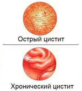 Хронический цистит – симптомы, причины, диагностика и лечение у женщин в «СМ-Клиника»