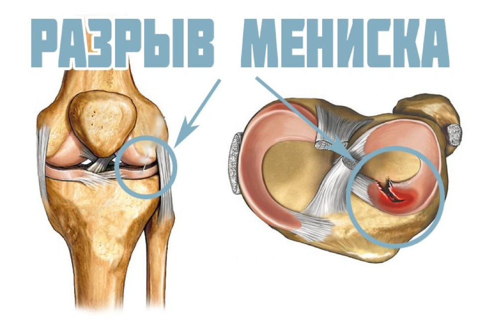 Разрыв мениска коленного. Разрыв мениска коленного сустава 3 а. Повреждён мениск коленного сустава симптомы. Разрыв рога мениска коленного сустава.