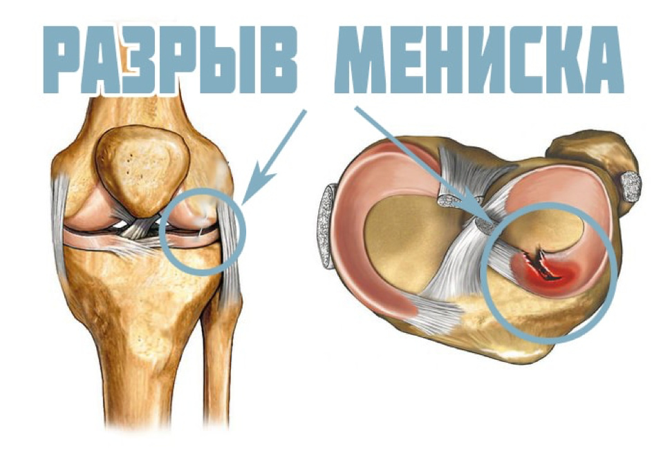 Структурные изменения мениска