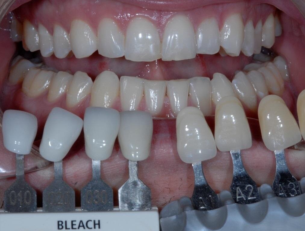 Искусственные зубы для съемных протезов