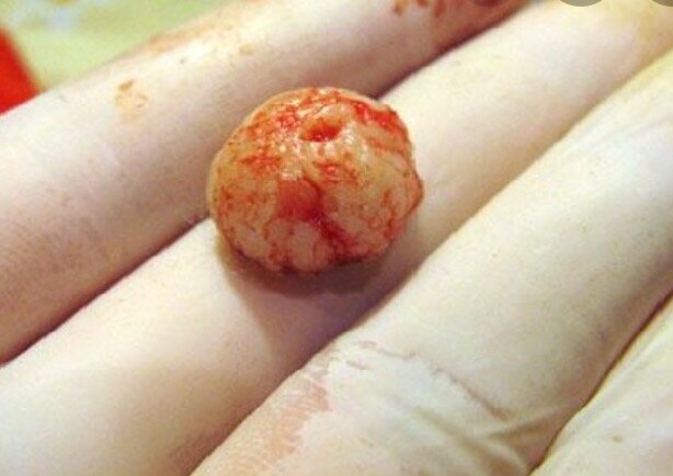 Фибролипома собственной персоной(фото из свободного доступа в интернете)