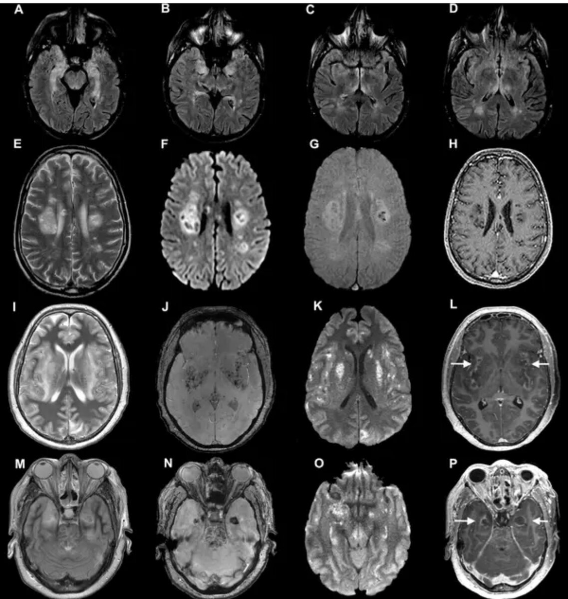 Сканирование мозга пациентов с коронавирусом из исследования, опубликованного в июле. Ученые обнаружили, что у некоторых развиваются серьезные неврологические осложнения, включая повреждение нервов.Кредит ...Росс У. Патерсон, Рэйчел Л. Браун и др. / Брейн, Oxford University Press