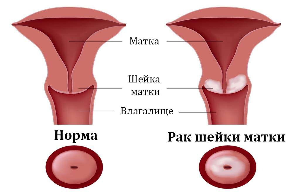 Доброкачественные опухоли влагалища: симптомы, причины, лечение и диагноститка