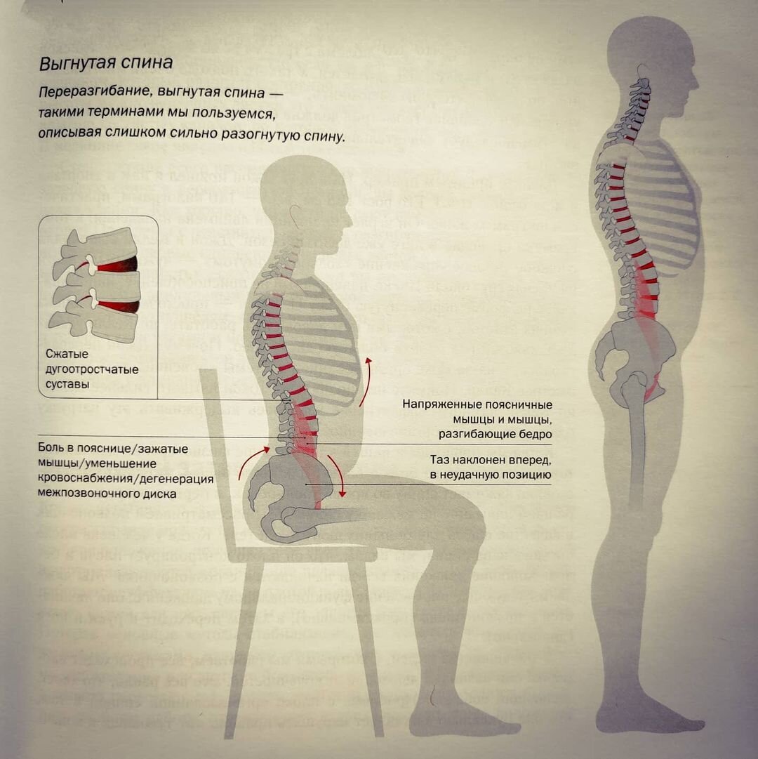 Подвздошно поясничная мышца лордоз