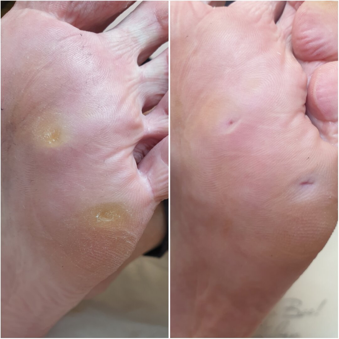 Мозоли на стопе