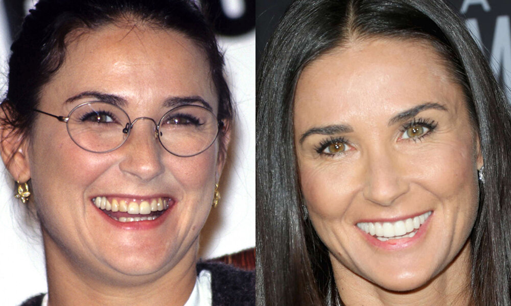 Как виниры помогли звездам