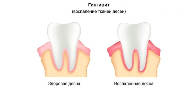Источник: https://ozubkah.ru