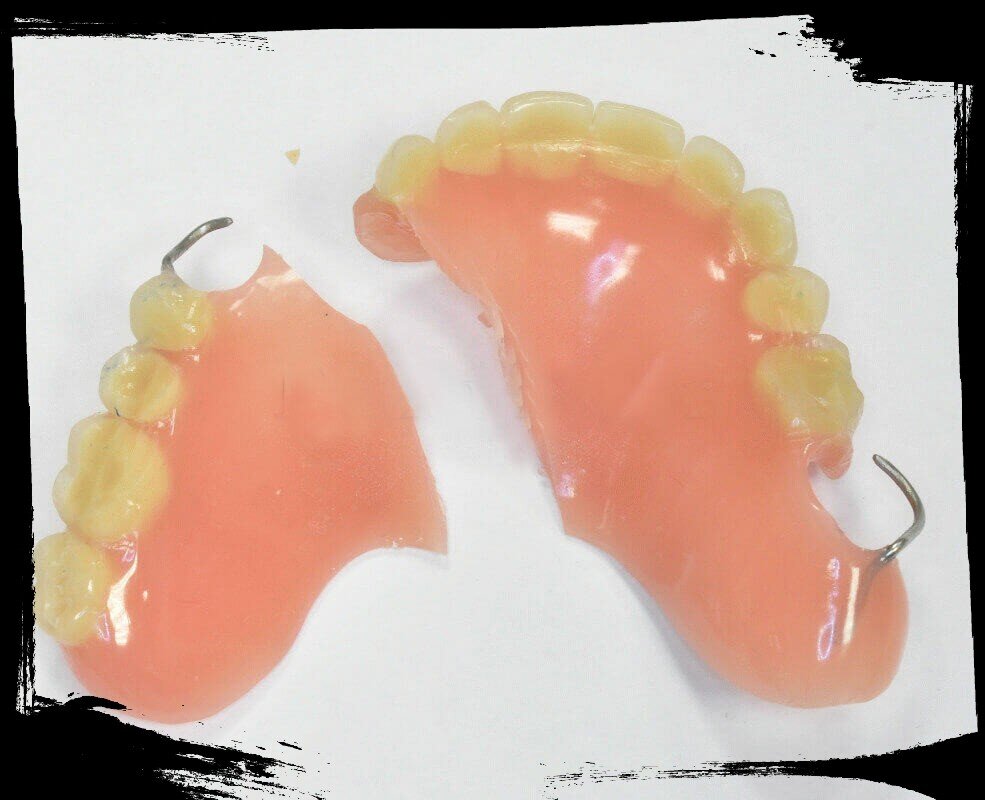 Перелом протеза