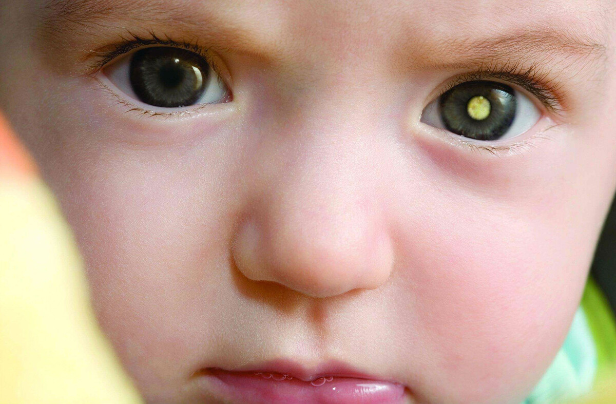 Ретинобластома встречается чаще у детей