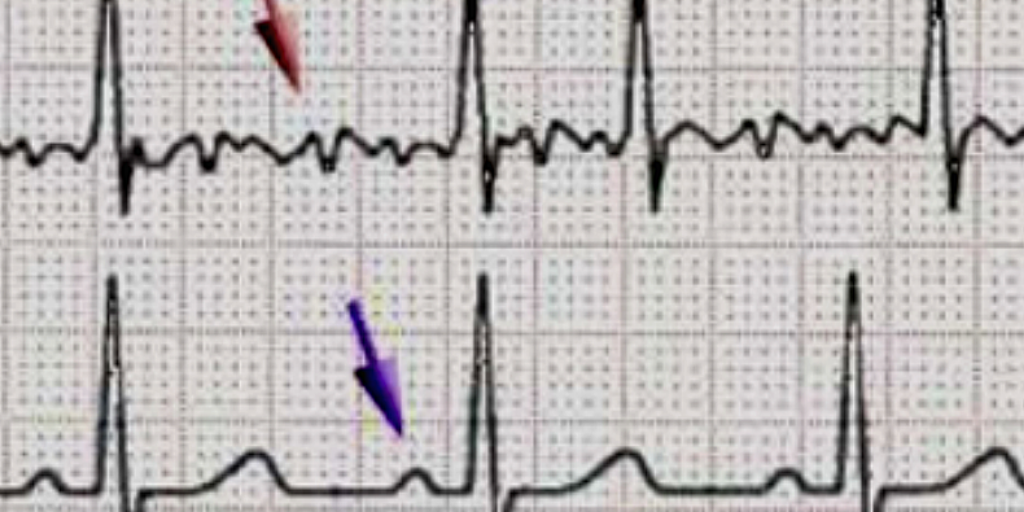 Электрокардиограмма.Вверху,указано красной стрелочкой, аритмия,внизу-нормальная ЭКГ.