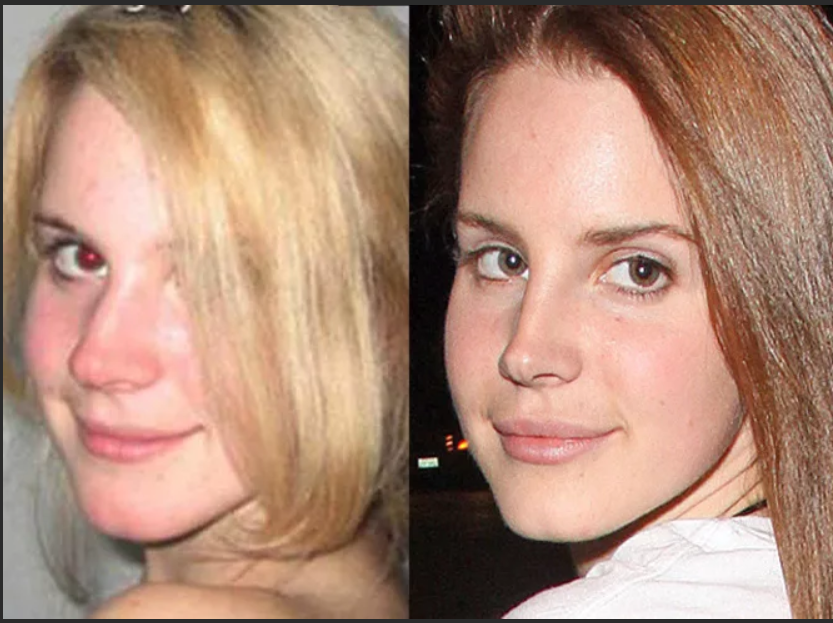 Lana Del Rey Plastic Surgery, Lip Injections And Botox Lana del rey, Plastic sur