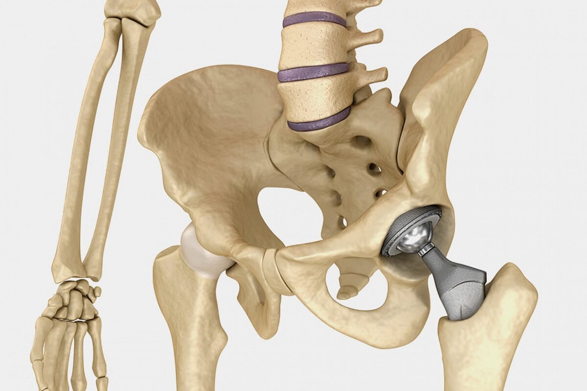 Бедренный эндопротез. Ревизионное эндопротезирование тазобедренного сустава. Коксартроз эндопротезирование тазобедренного сустава. Артралгия тазобедренного сустава. Гемиартропластика тазобедренного сустава.
