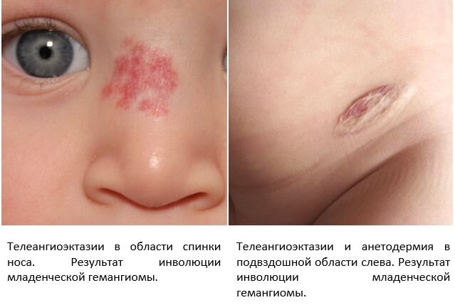 Иллюстрации из книги "Гемангиома" , автор Романов Д.В. 2022