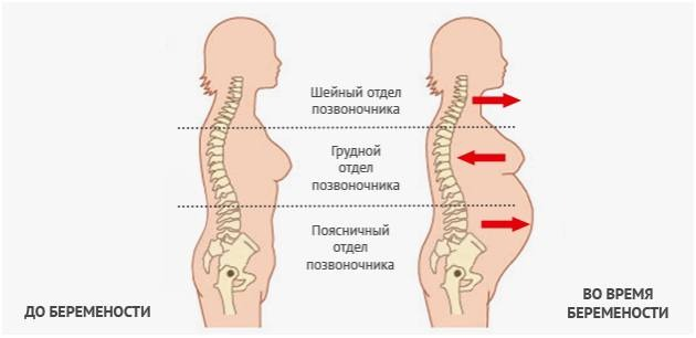                                 наглядный пример, какие изменения происходят в позвоночнике.