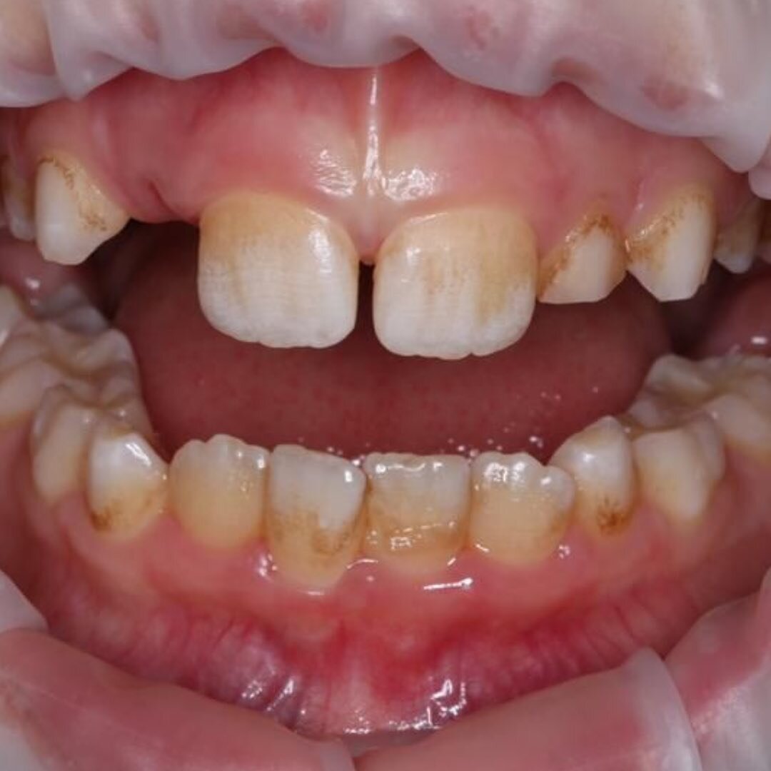 Вот так выглядит налет после приема препаратов 