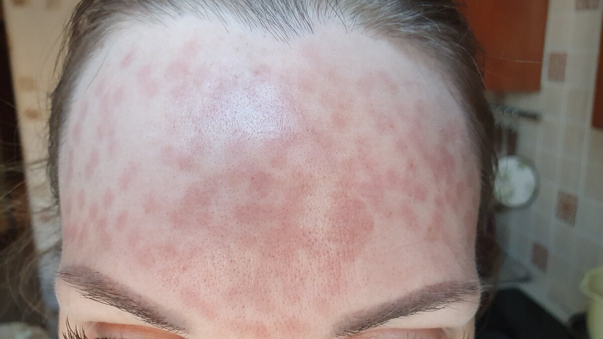 Первый день после пилинга лицо покрывается коричневыми пятнами, и держится до одной недели. Поэтому на несколько дней придется отказаться от массовых мероприятий.