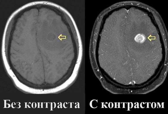 Так примерно всё выглядело, но не на мозге, а на всём теле