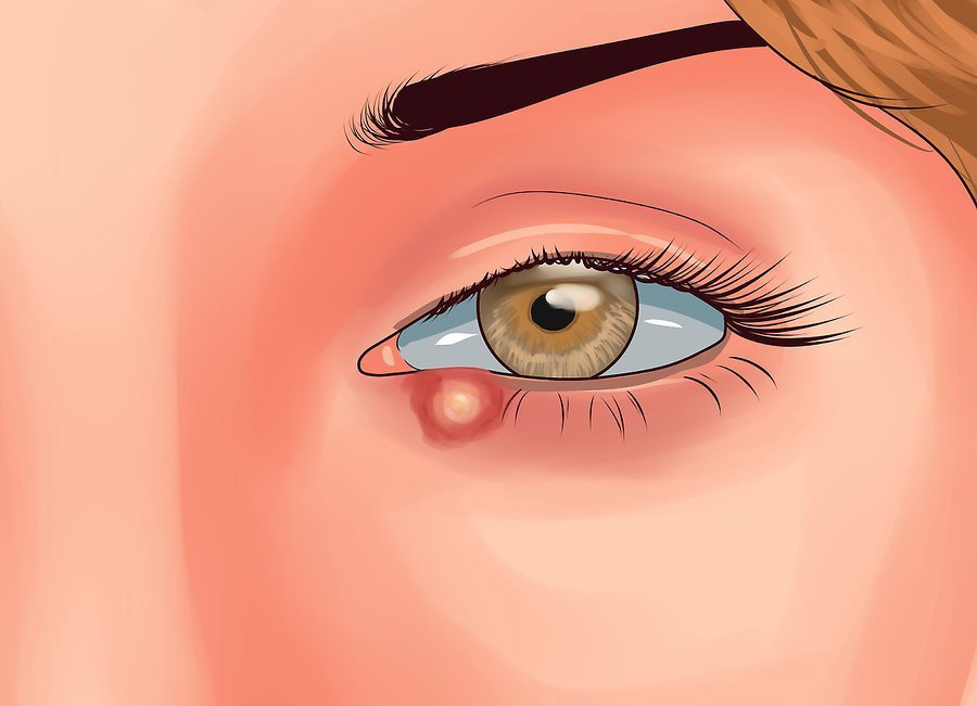 Лечение ячменя на глазу. Халязион мейбомиевых желез. Халязион у детей верхнее веко.