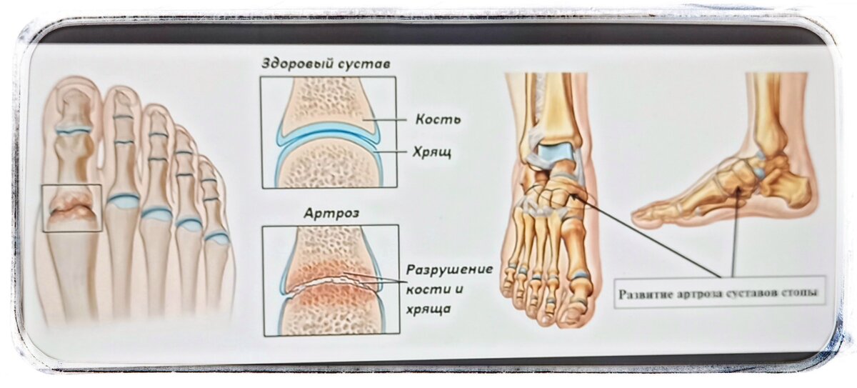 Питание при артрозе коленного сустава. Диета при артрозе коленных суставов, разрешенные и запрещенные продукты Питание при гонартрозе коленного сустава 2 степени Питание при артрозе коленного сустава