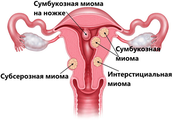 Яндекс картинки. Расположение миомы матки.