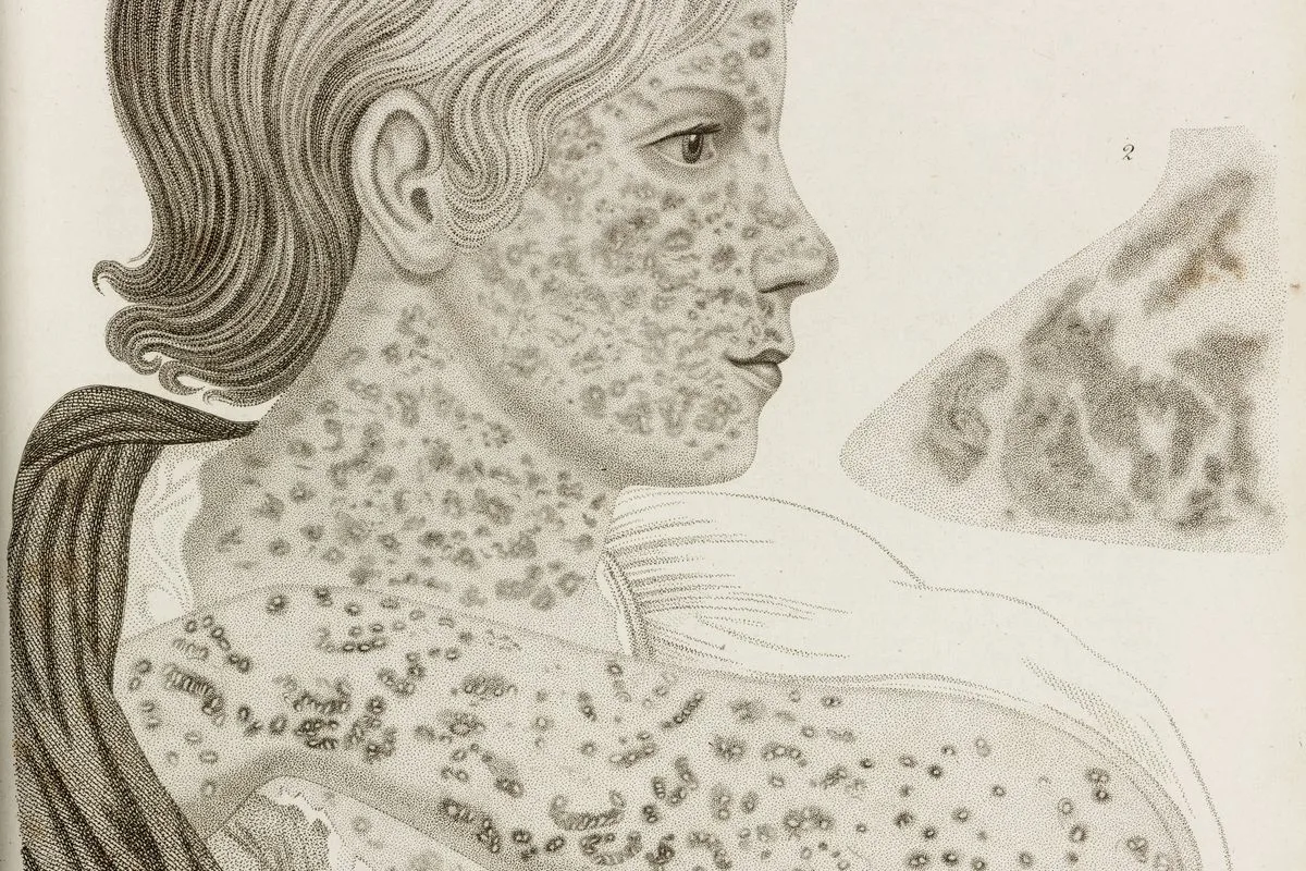 Картина кори. Основные клинические проявления краснухи. Характерные клинические симптомы кори. Картина кори. Картина кори.