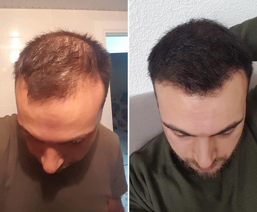 Руслан белый после пересадки волос фото до и после