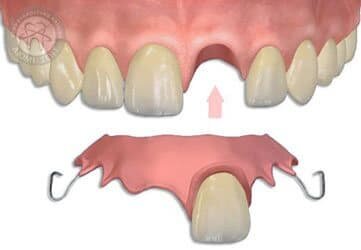 Временный протез с металлическими кламмерами