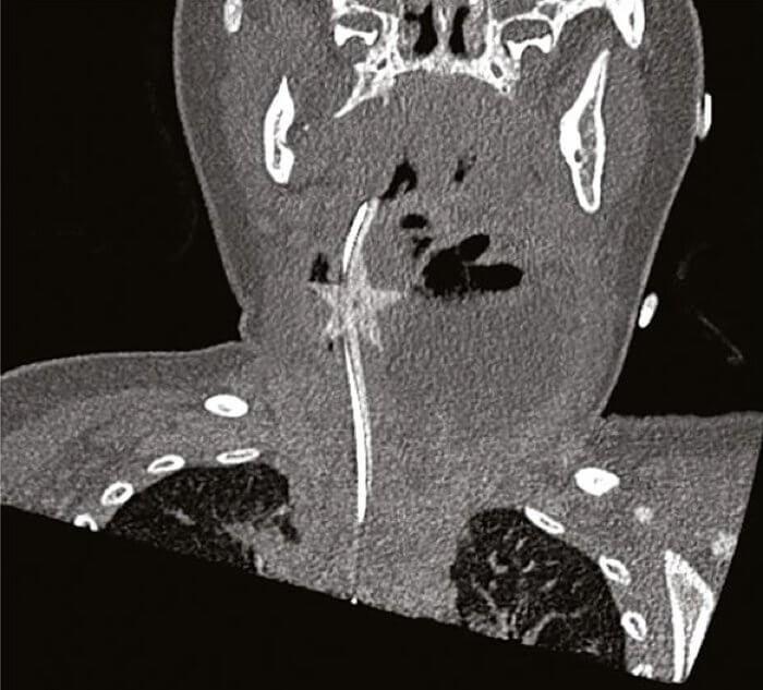 Частичка конфетти, обнаруженное в горле ребенка