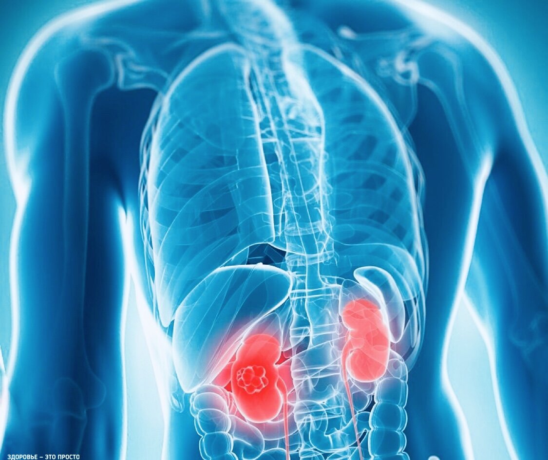 Красным цветом отмечено, где находятся почки, причём, тут они явно чувствуют себя не очень 