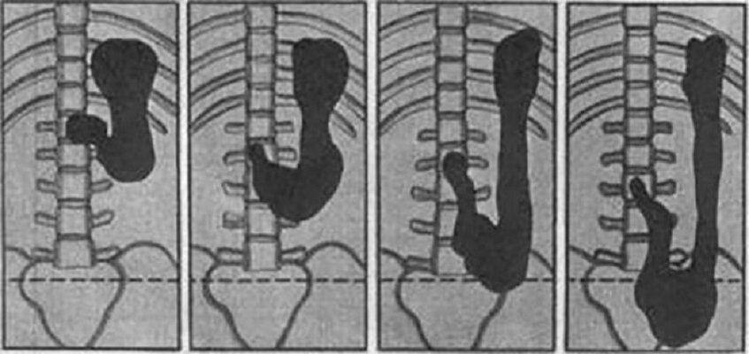 Норма, 1,2,3 стадии гастроптоза (слева направо)