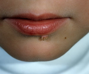 травяной настой для укрепления иммунитета при лечении папиллом – возьмите по столовой ложке таких лекарственных средств, как хвоща, мелиссы, корня одуванчика, подорожника и крапивы , измельчите их и соедините. Несколько ложек такой смеси заливаем литром кипятка и провариваем в течение 10 минут на огне. Настаиваем отвар в течение 4 часов и можем принимать перед едой по 50 мл по три раза в день в течение недели;