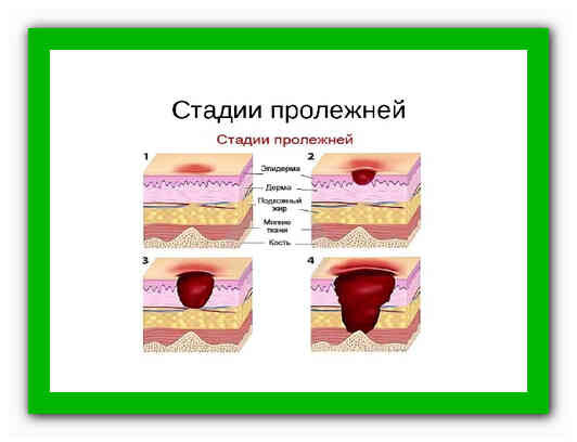 Стадии пролежней рисунки