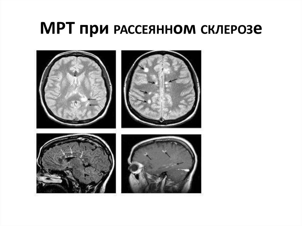 Склероз мозга симптомы