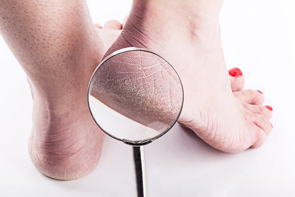 Шелушится кожа на ногах: причины появления шелушения, сухости, зуда стоп и пальцев, лечение микоза